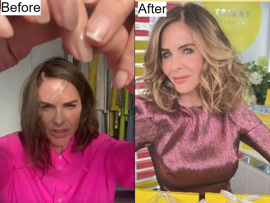 Trinny hair loss struggles to hair recovery success: A before-after display of transformation.
